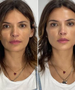 Radiesse filler