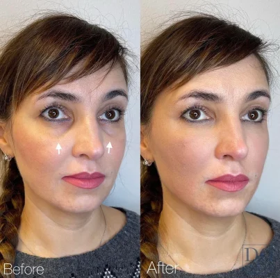 fat grafting breast and face 12 fat grafting