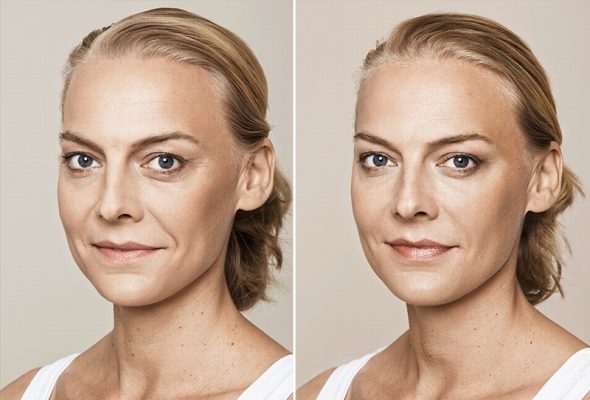 Restylane filler 10 Restylane filler