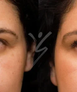Restylane filler 6 Restylane filler