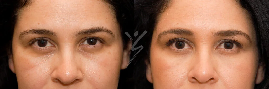 Restylane filler 3 Restylane filler