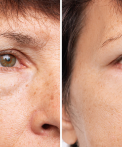 Restylane filler​