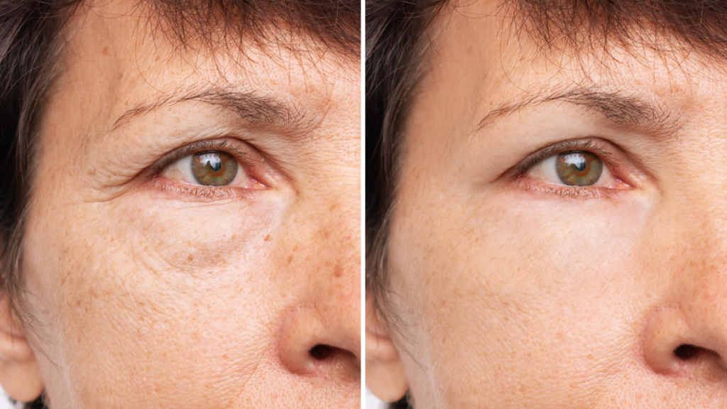 Restylane filler 2 Restylane filler