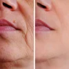 Restylane filler 9 Restylane filler