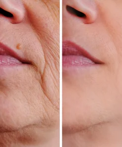 Restylane filler