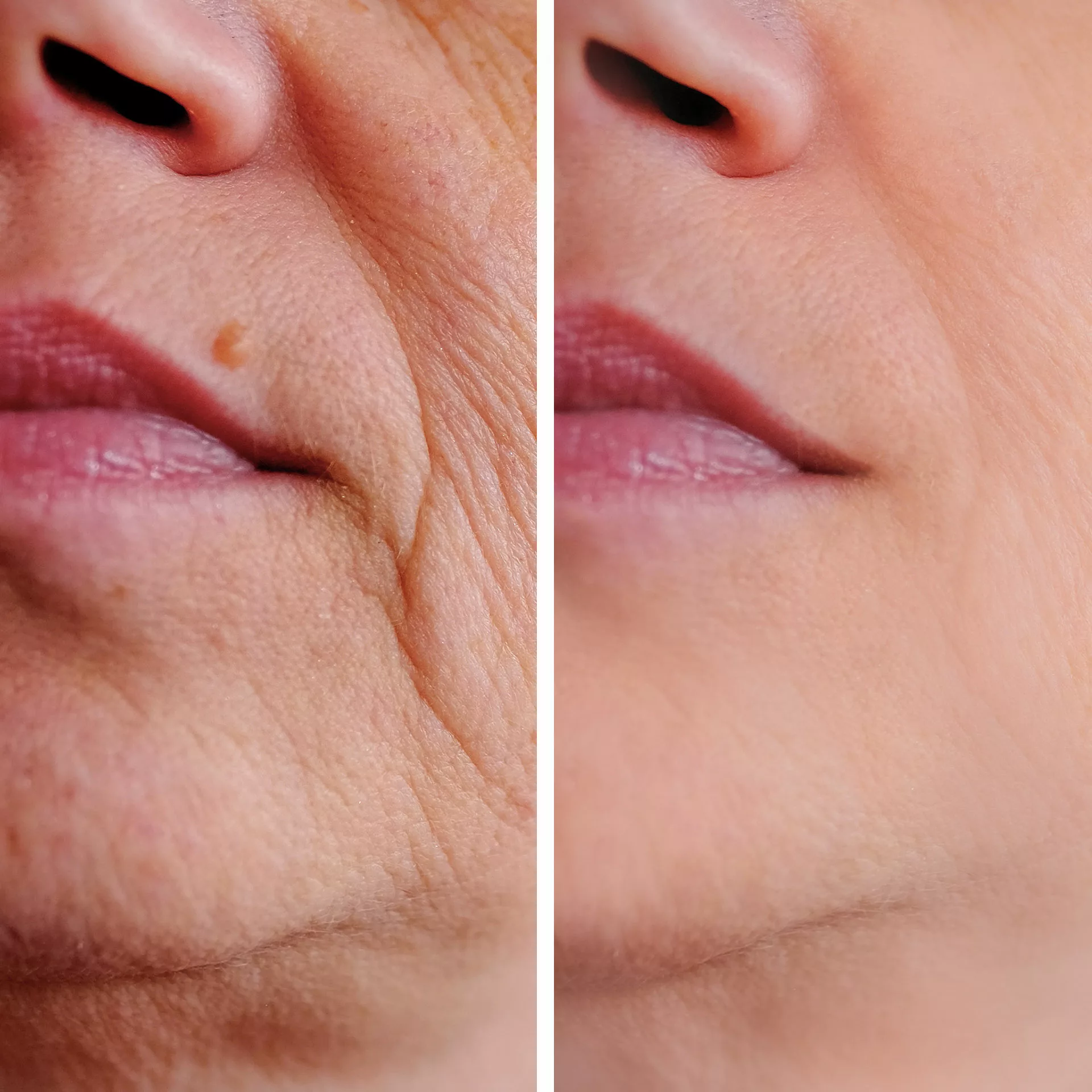 Restylane filler 1 Restylane filler