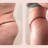 brazilian butt lift bbl