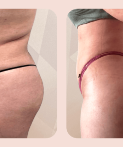 brazilian butt lift bbl