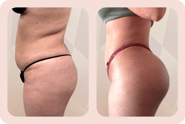 brazilian butt lift bbl
