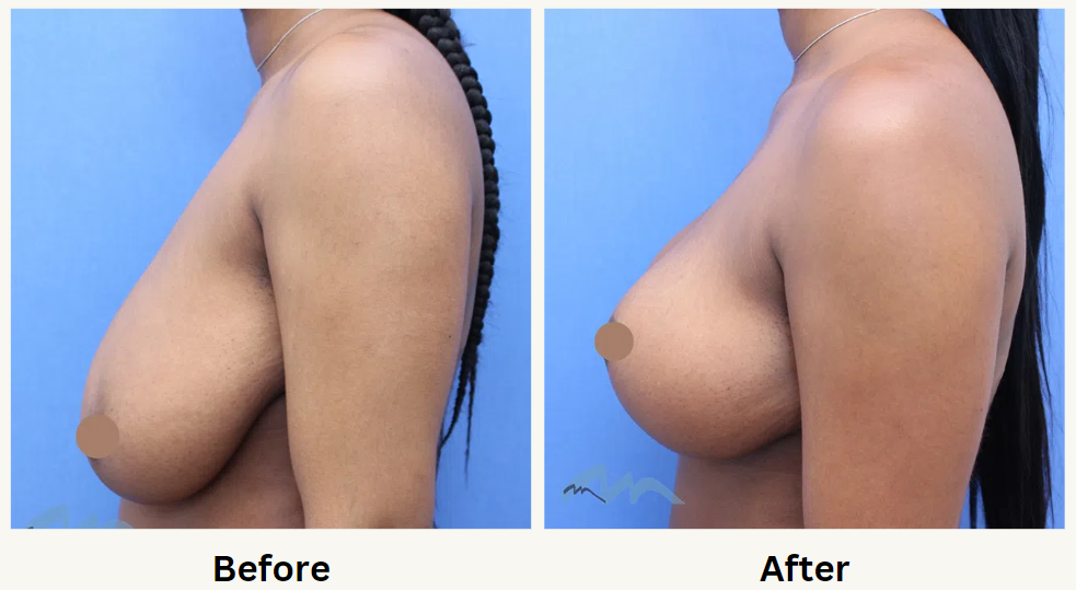 Breast lift 34