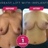 breast lift