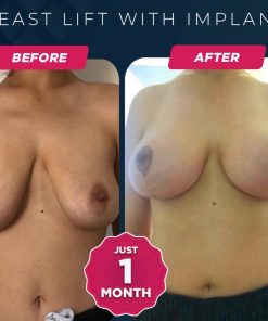 breast lift