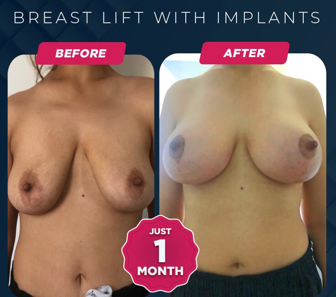 Breast Lift Before and After 1 breast lift