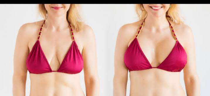 Breast Lift Before and After 14 breast lift