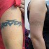 Tattoo Removal Cream