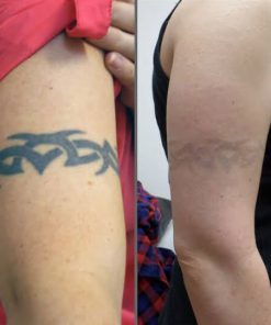 Tattoo Removal Cream